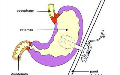 gastrotomie