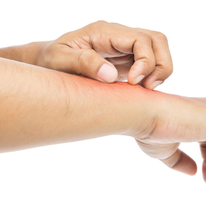 Utilisation du Dupilumab dans l’EB