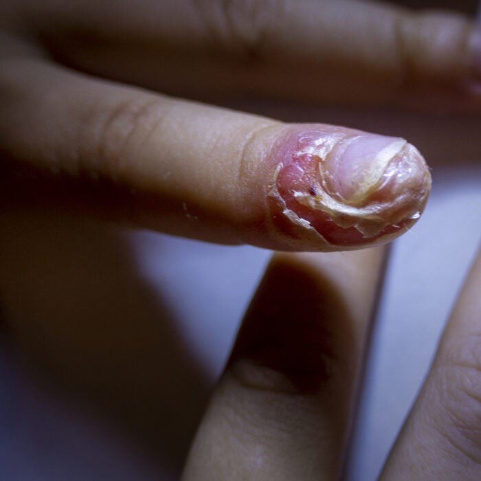 Épidermolyse bulleuse : les ongles, un indicateur à ne pas négliger